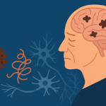 Alzheimer-kór: új eredmények